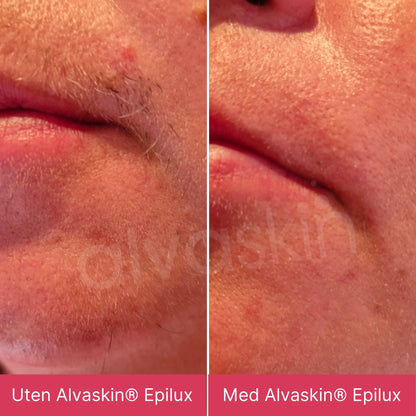 Alvaskin® Epilux