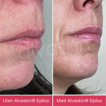 Alvaskin® Epilux