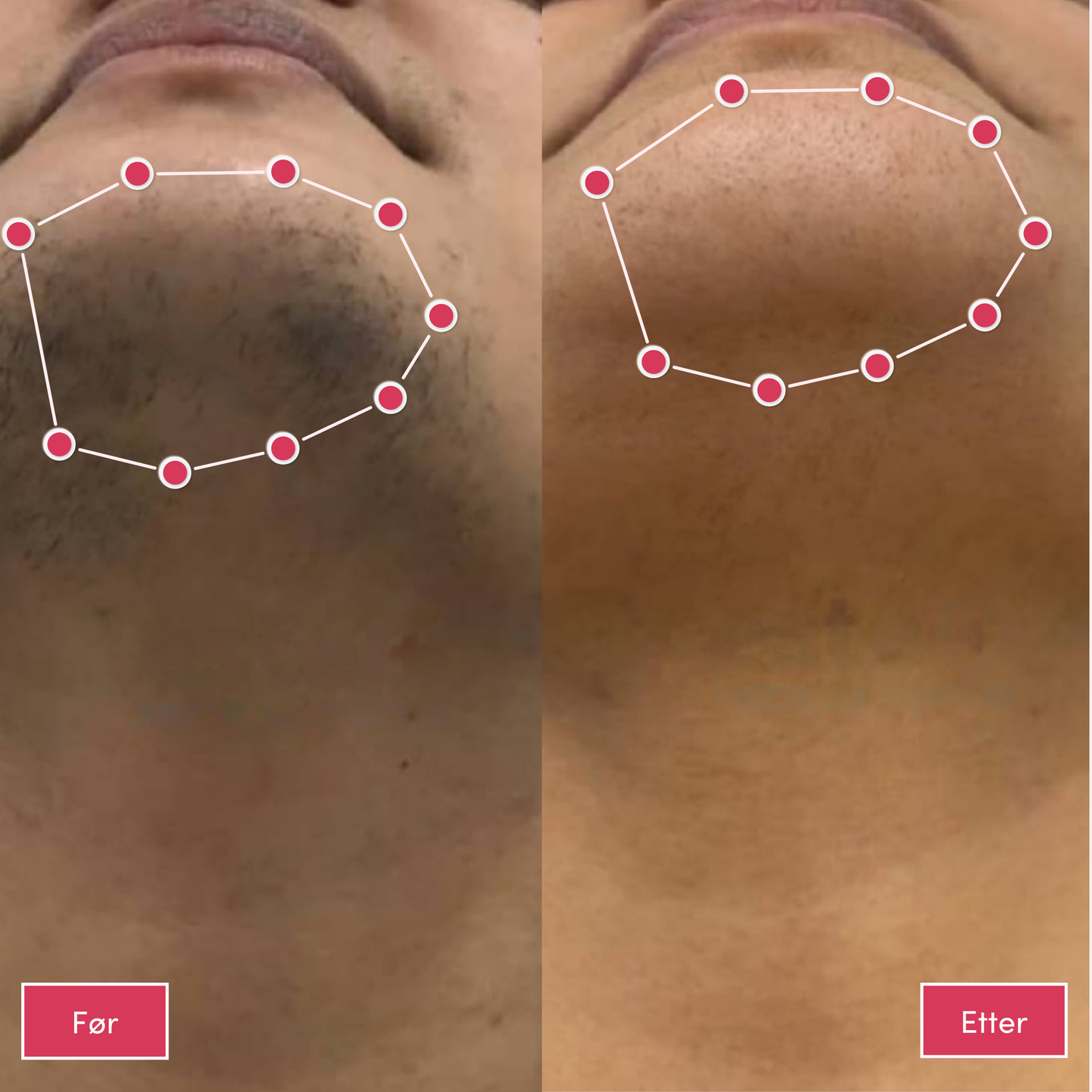 Alvaskin® IPL-laser