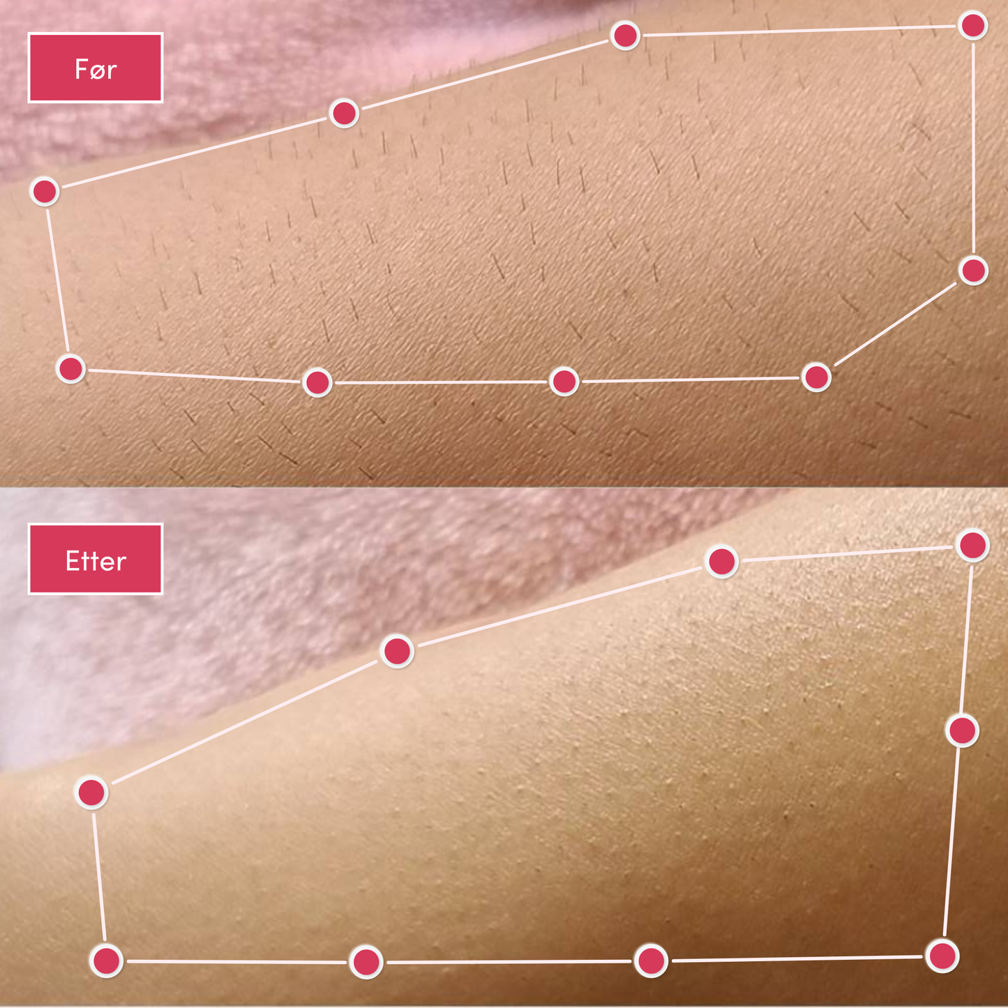 Alvaskin® IPL-laser