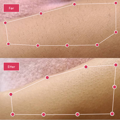 Alvaskin® IPL-laser