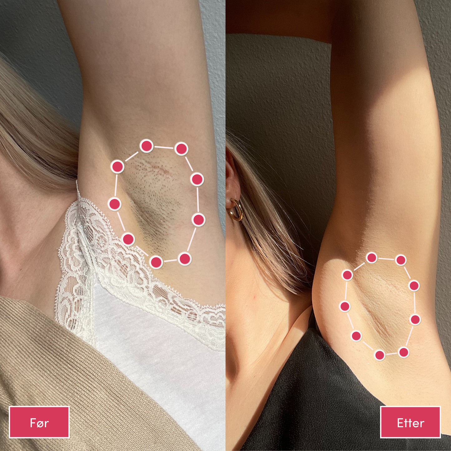 Alvaskin® IPL-laser
