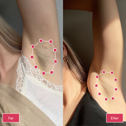 Alvaskin® IPL-laser