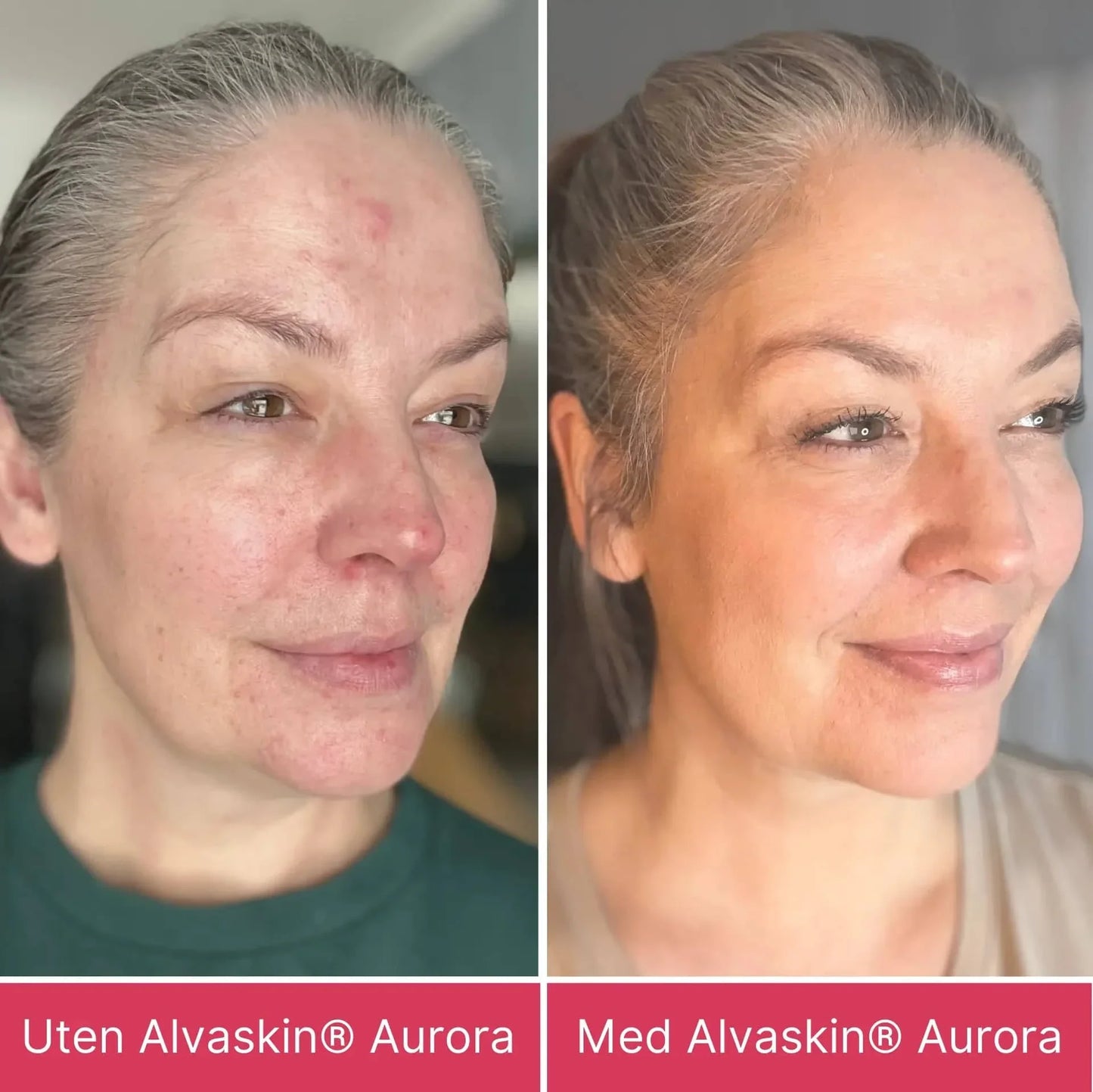 Alvaskin® Aurora