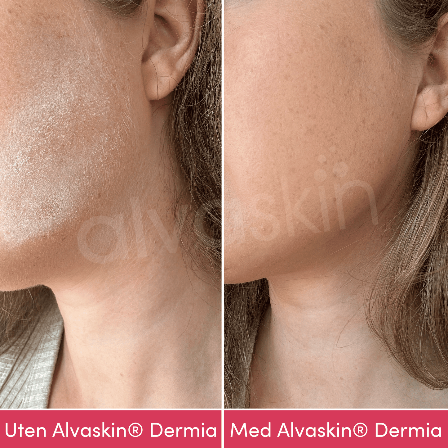 Alvaskin® Dermia