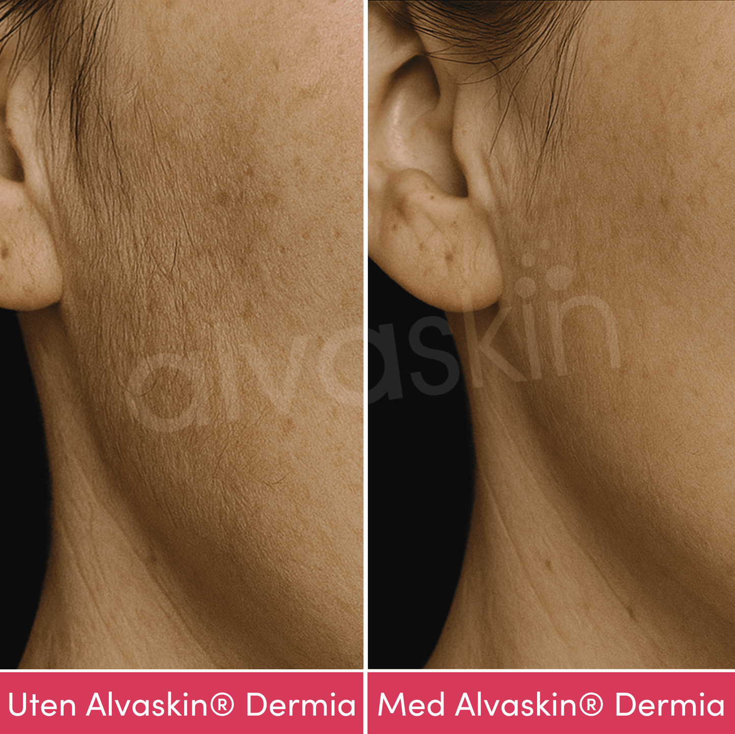 Alvaskin® Dermia