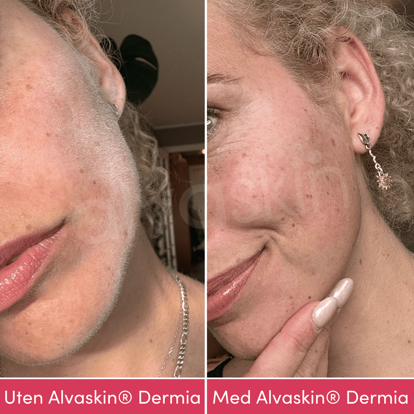 Alvaskin® Dermia
