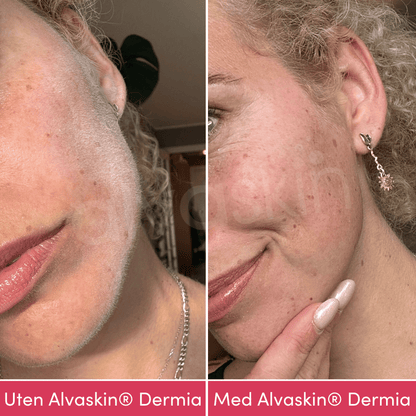 Alvaskin® Dermia