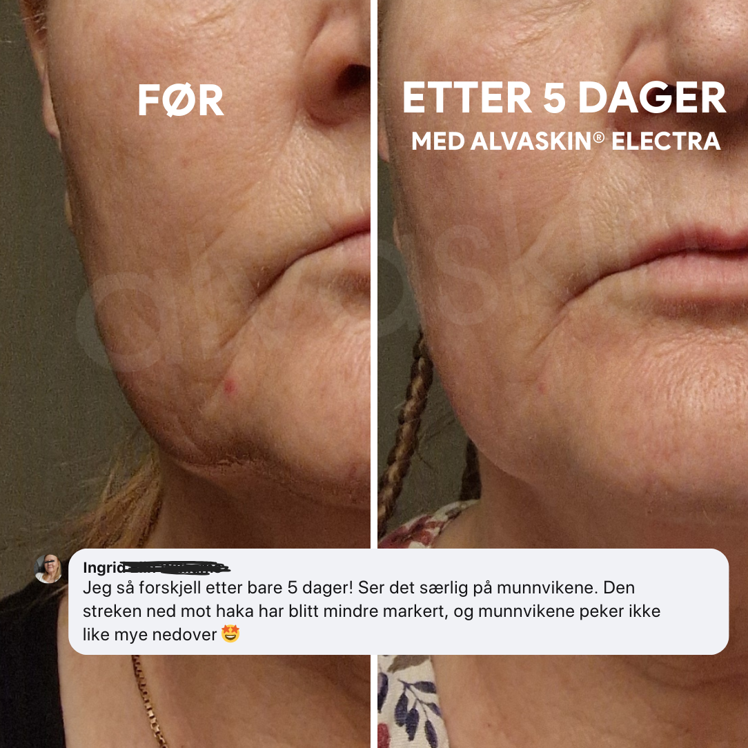 Alvaskin® Electra